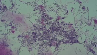 Bacterial vaginosis - Candidiasis - Candida albicans