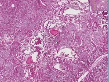 Legionella pneumonia
