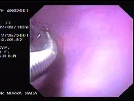 Hemorrhage due status post rubber band ligation of esophageal varices (7 of 25)