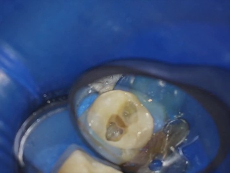 1 Minute Clinical Canal Blockage Tips