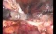 Laparoscopic Hysterectomy- Pelvic Adhesions