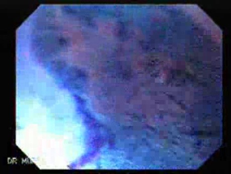 Barrett's Esophagus of long segment - chromoendoscopy using metyhene blue (9 of 24)