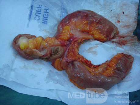 Meckele's diverticulum