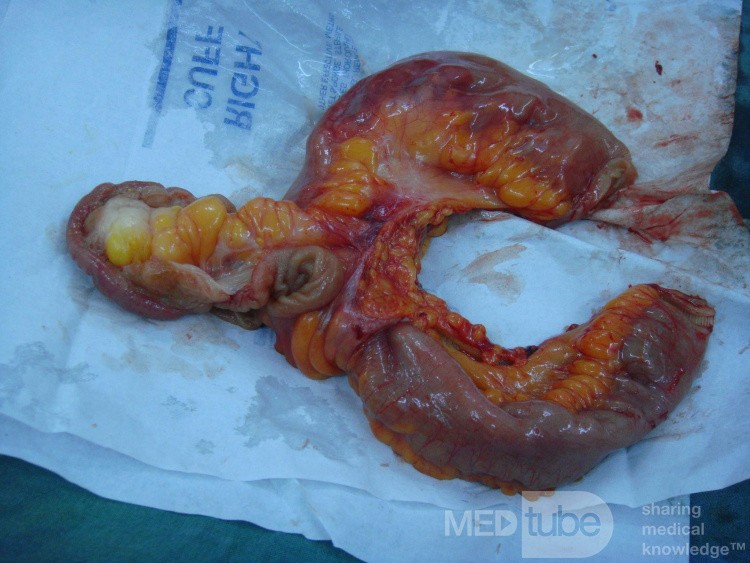 Meckele's diverticulum