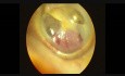 Glomus Tumor of the Left Ear