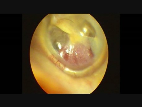Glomus Tumor of the Left Ear