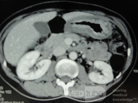 Endoscopy of Scirrhous Gastric Carcinoma involving the entire Fundus, Body and the Antrum (23 of 47)
