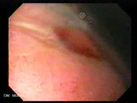 Gastroesophagic Varices (4 of 7)