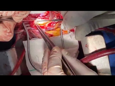 Pulmonary Artery Endarterectomy in Patient with CTEPH 