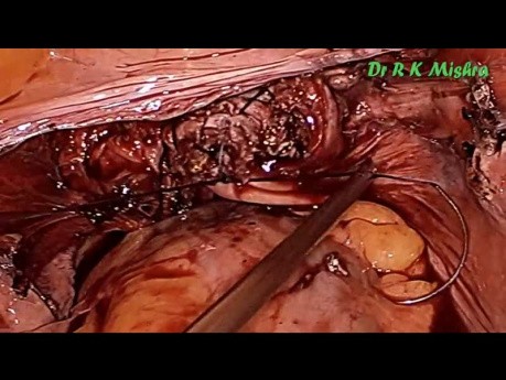 Laparoscopic Hysterectomy with Sacrocolpopexy for Uterine Prolapse in Elderly Women