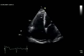 Impaired Right Ventriculi Function