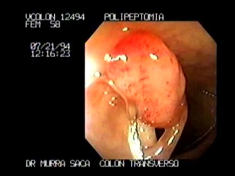 Endoscopic snare excision of large pediculated Polyp (2 of 5)