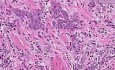 Prostate - Adenocarcinoma (Gleason grade 5) - Histopathology