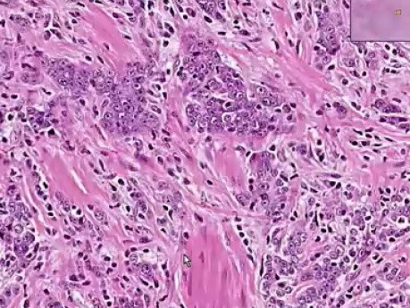 Prostate - Adenocarcinoma (Gleason grade 5) - Histopathology