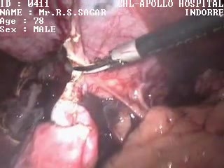 Laparoscopic removal of Liver cyst