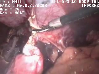 Laparoscopic removal of Liver cyst