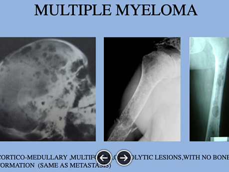 Surgical Radiology Of Bone Tumours