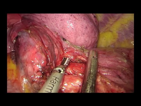 Subxiphoid Uniportal Video-assisted Thoracoscopic Left Lower Lobectomy
