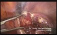 Single Incision Laparoscopic Polymyomectomy