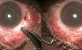 Failed Anterior Filtration, VR Surgery Case with Perilimbal Scarring Allround, Reverse Cyclodialysis Done