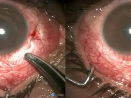 Failed Anterior Filtration, VR Surgery Case with Perilimbal Scarring Allround, Reverse Cyclodialysis Done