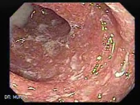 Rectum (13 of 30)
