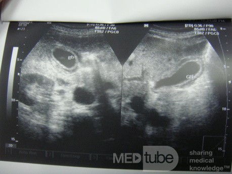 Acute acalculus cholecystitis - on ultrasound