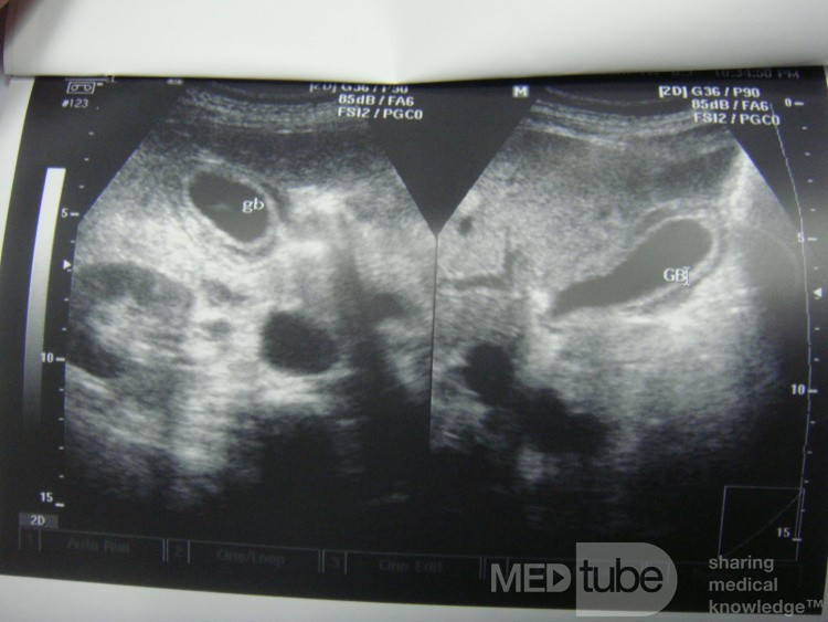 Acute acalculus cholecystitis - on ultrasound