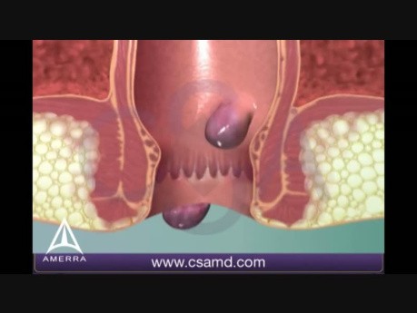 Hemorrhoids - 3D Medical Animation