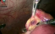 Adhesive Intestinal Obstruction