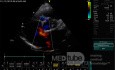 Ostium Secundum Atrial Septal Defect (ASD)