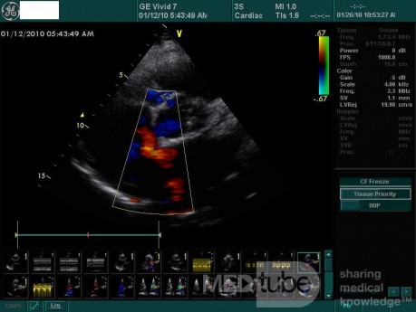 Ostium Secundum Atrial Septal Defect (ASD)