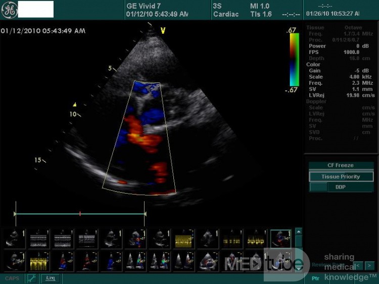 Ostium Secundum Atrial Septal Defect (ASD)