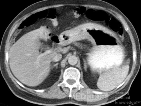 ScirrhousGastric Carcinoma (Linitis Plastica) (9 of 9)