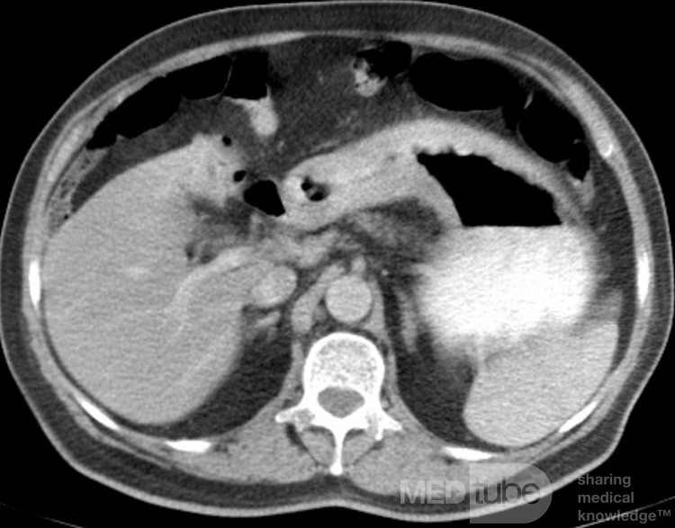 ScirrhousGastric Carcinoma (Linitis Plastica) (9 of 9)