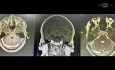 Right Middle Fossa Approach for Resection of a GG Lesion