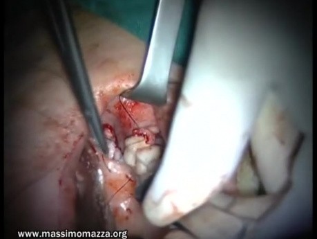 Regeneration Of Multialveolar Process 16-17 (3/4