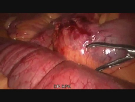 Fibrous Band Intestinal Obstruction