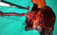 Left Hepatectomy extended to Segment I, for Type IIIb Colangiocarcinoma