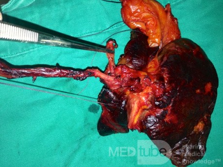 Left Hepatectomy extended to Segment I, for Type IIIb Colangiocarcinoma