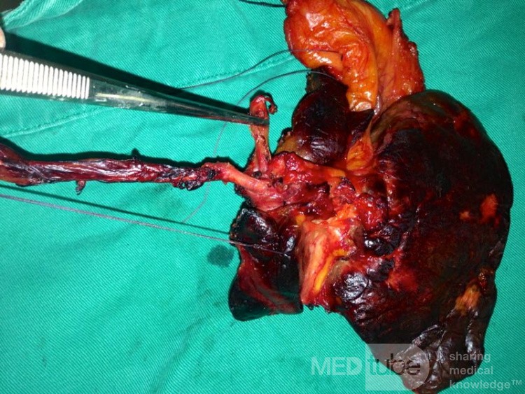 Left Hepatectomy extended to Segment I, for Type IIIb Colangiocarcinoma