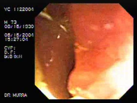 Crohn´s Disease of the Ileocecal Valve and Terminal Ileum (5 of 5)