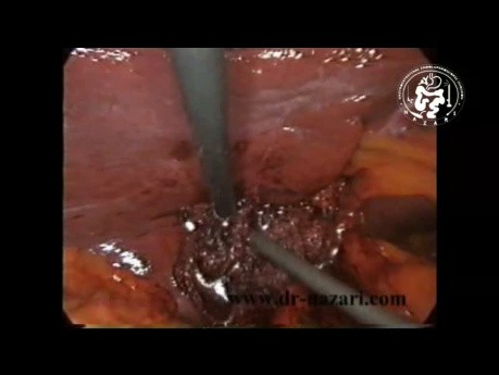 Gallbladder Agenesis
