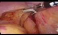 TaTME (Transanal Total Mesorectal Excision) for Low Rectal Cancer
