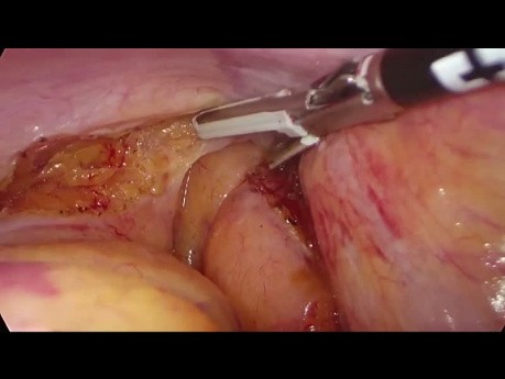 TaTME (Transanal Total Mesorectal Excision) for Low Rectal Cancer