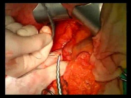 Open Right Hemicolectomy – Technical Principles - Operation No 1B - Part 1