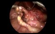 Laparoscopic Ladd's Procedure in a Neonate with Mid Gut Malrotation