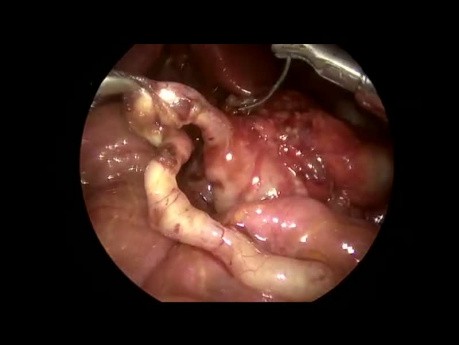 Laparoscopic Ladd's Procedure in a Neonate with Mid Gut Malrotation