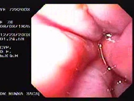 Hemorrhage Due Status Post Rubber Band Ligation of Esophageal Varices - Source of Bleeding, Part 1