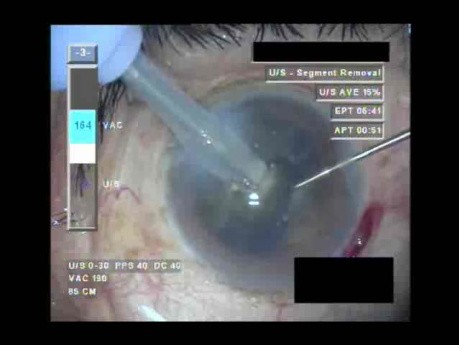 Cataract Surgery IV - Part 3